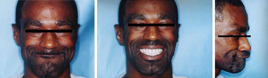 Full mouth reconstruction