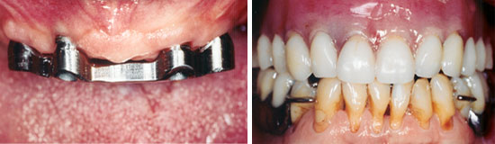 Implant bridge