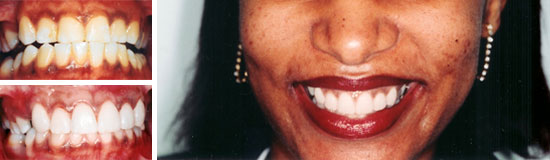 Gummy smile
