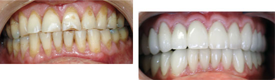 Veneers