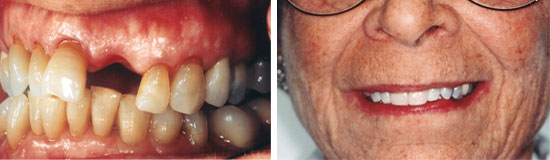 Single Implant for missing tooth