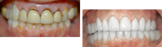 Porcelain veneers