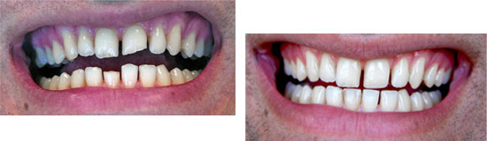 Composite bonding