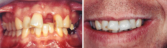 Smile makeover