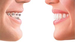 Invisalign or Clear Straightening of the Teeth