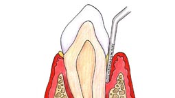 Periodontal Disease Treatment