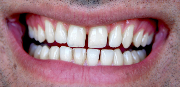 Cosmetic Dentistry Bonding