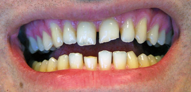 Broken Tooth