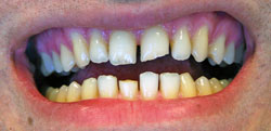 Broken Tooth